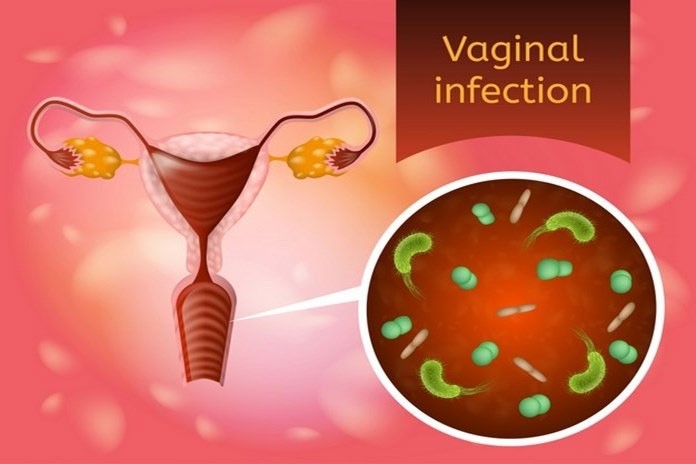 Vrste vaginalnih infekcija
